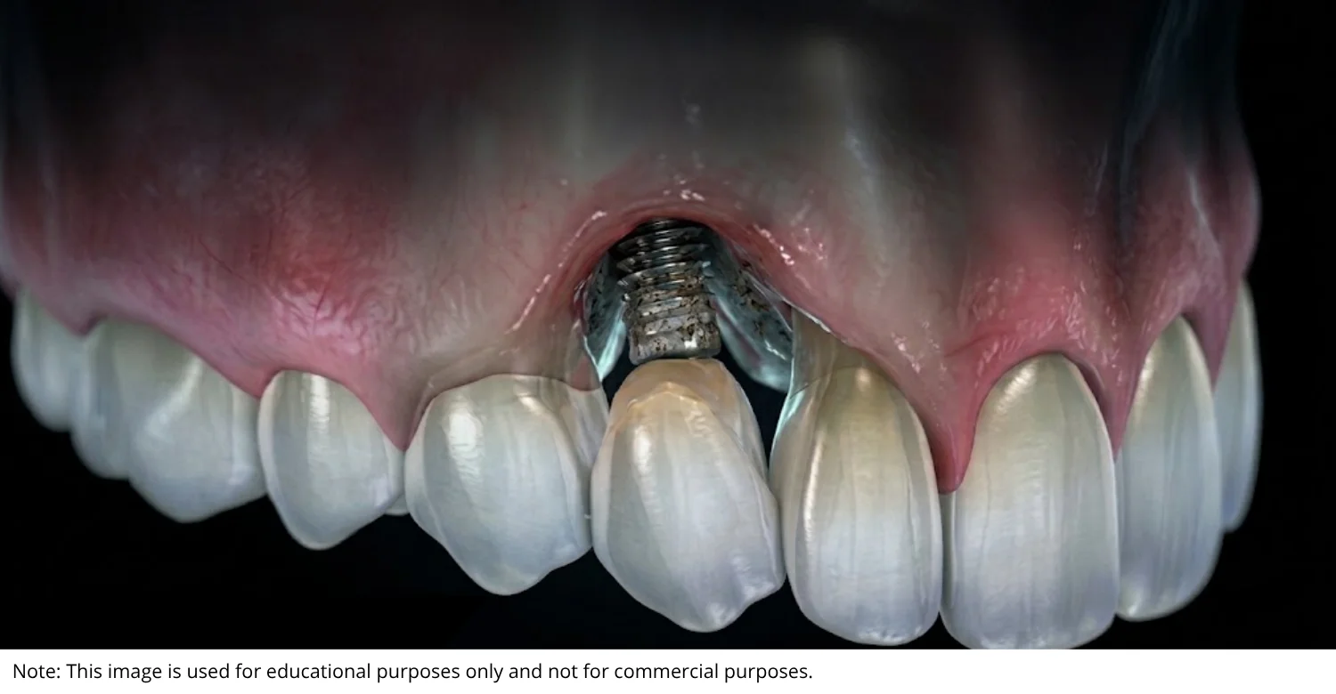 Dental Implant Failure in Patients With Diabetes INBLOG